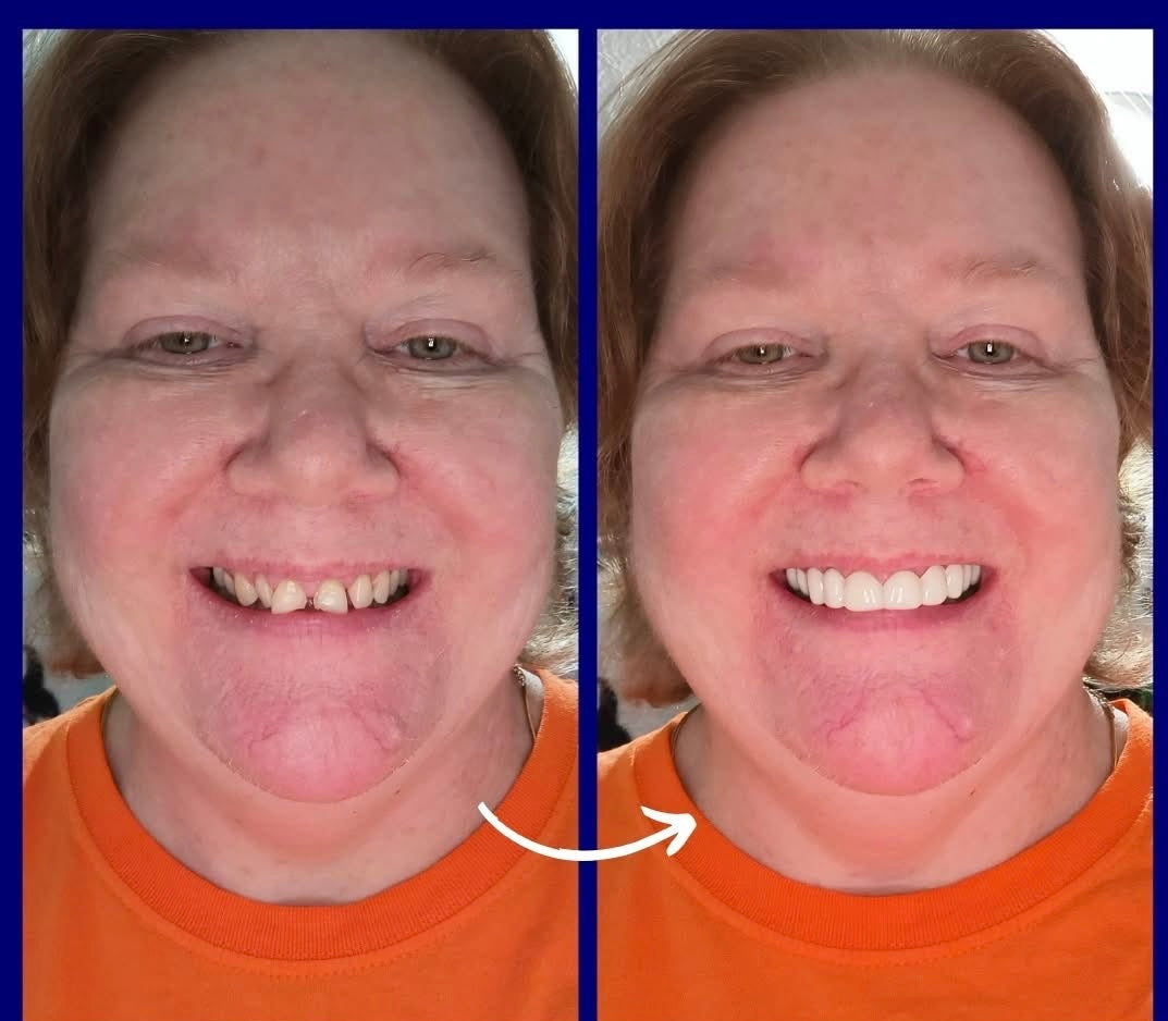 Snap On Smile (CZ) 9