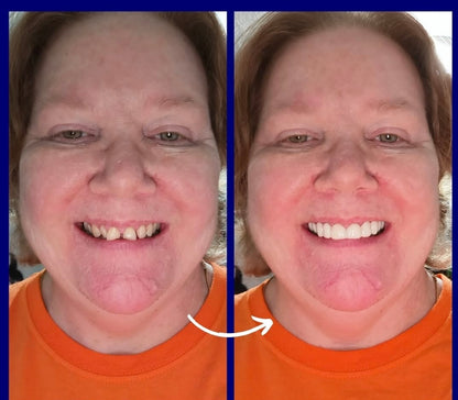 Snap On Smile (CZ) 9