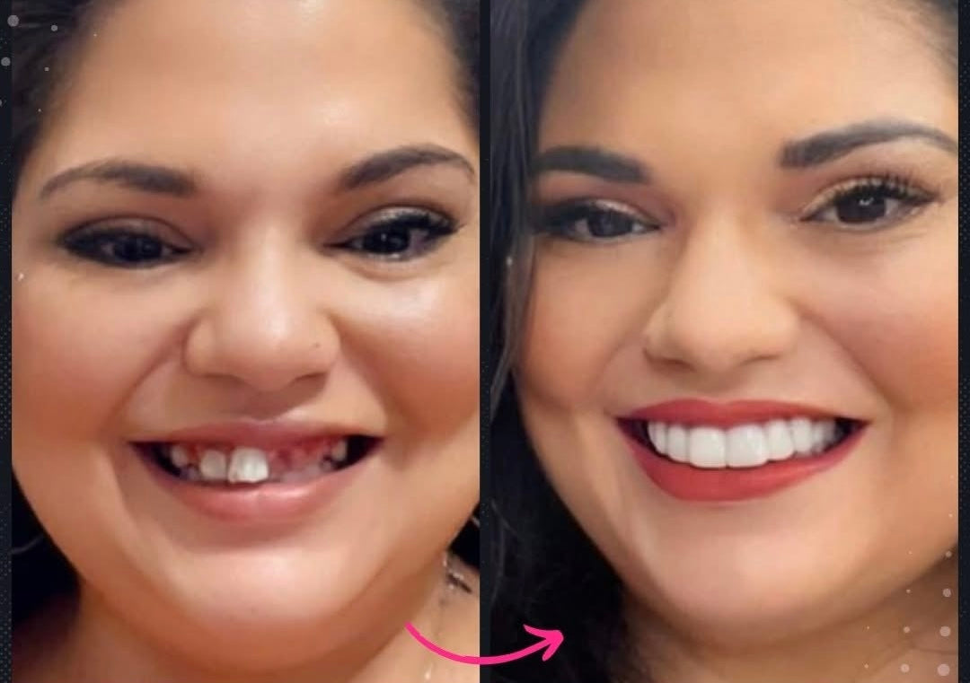 Snap On Smile (CZ) 10