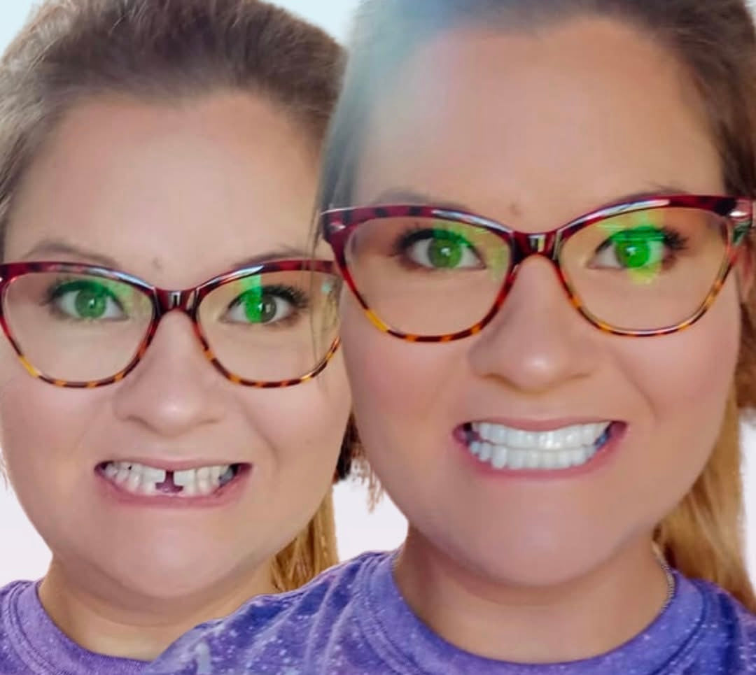 Snap On Smile (CZ) 5