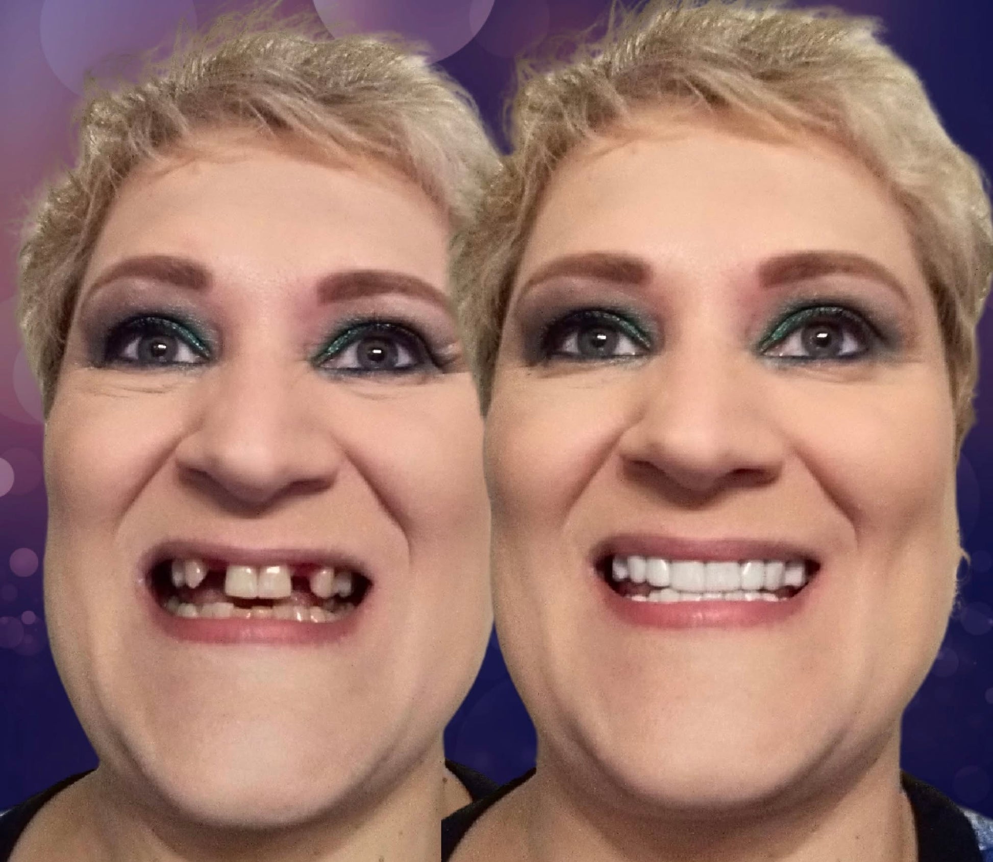 Snap On Smile (CZ) 4