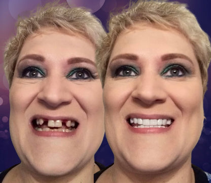 Snap On Smile (CZ) 4