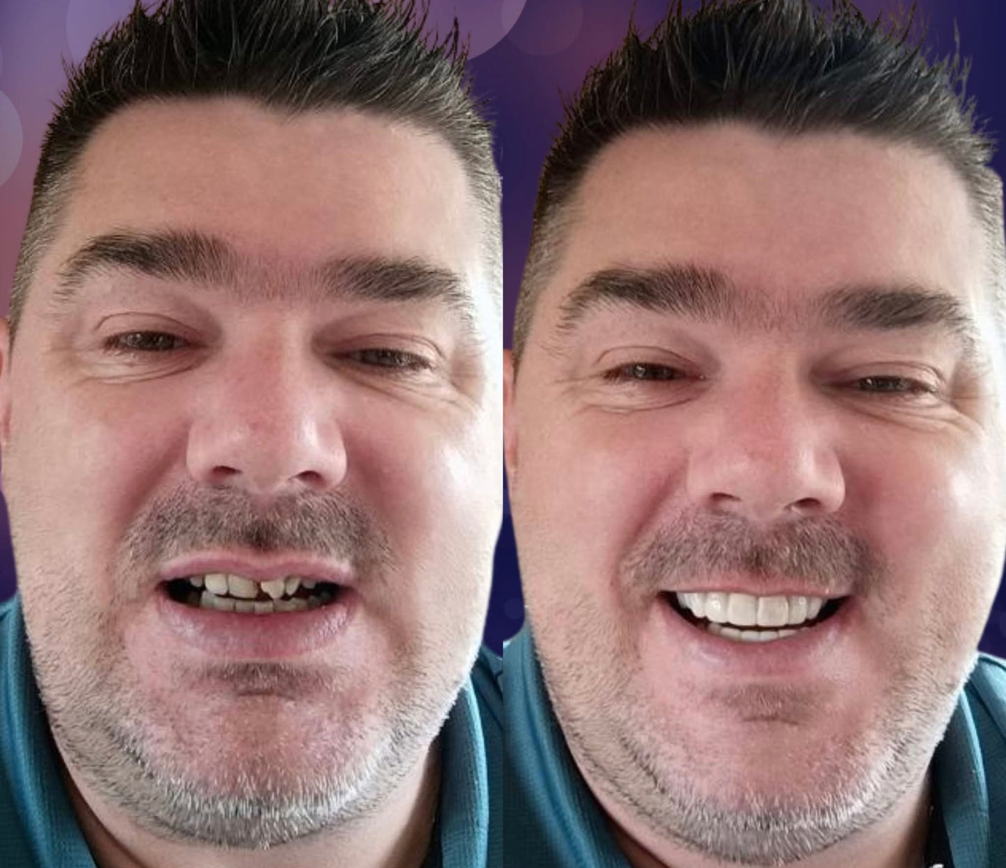 Snap On Smile (CZ) 6