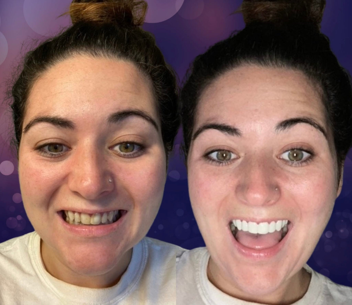 Snap On Smile (CZ) 7