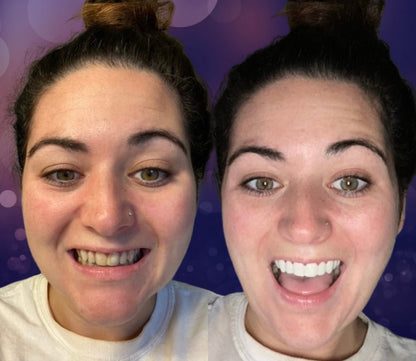 Snap On Smile (CZ) 7