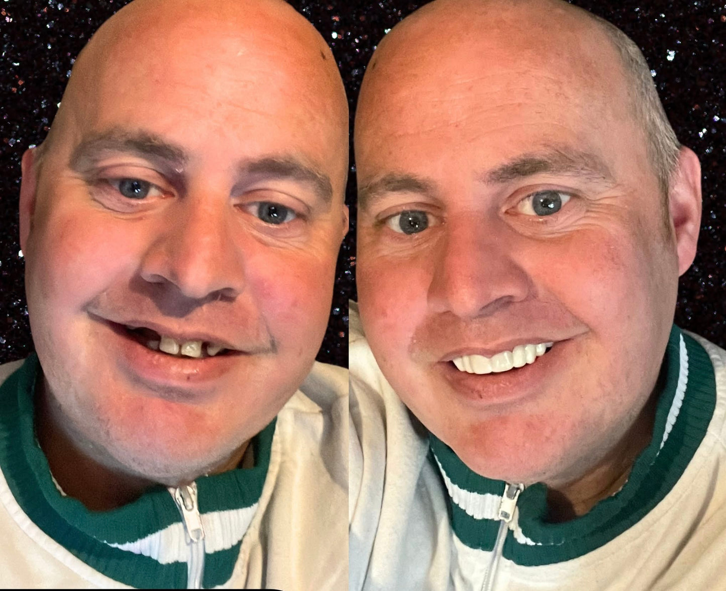 Snap On Smile (CZ) 8