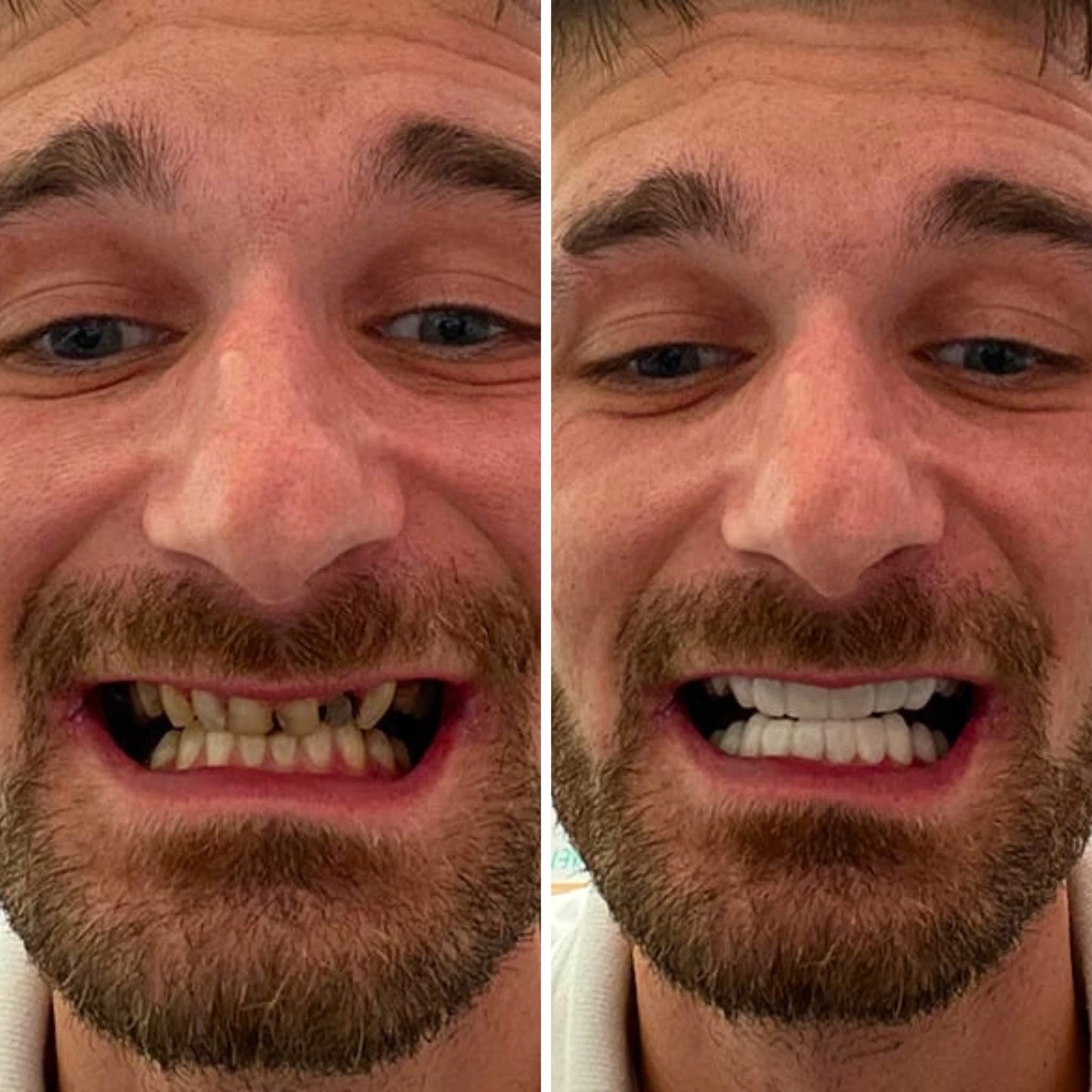 Snap On Smile (CZ) 1