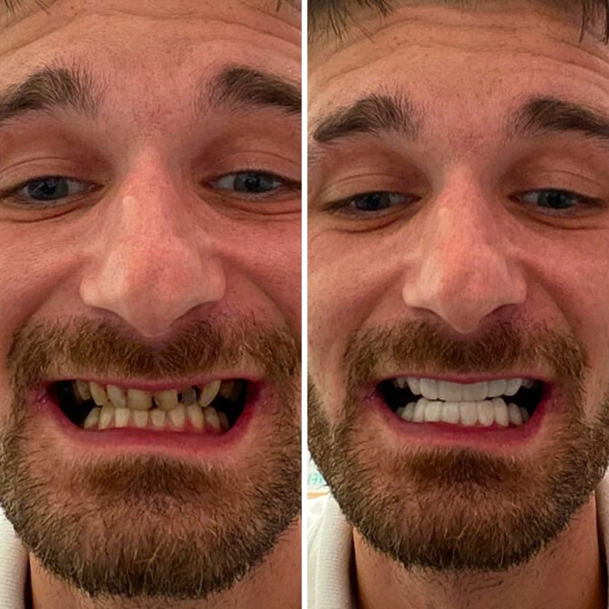 Snap On Smile (CZ) 1