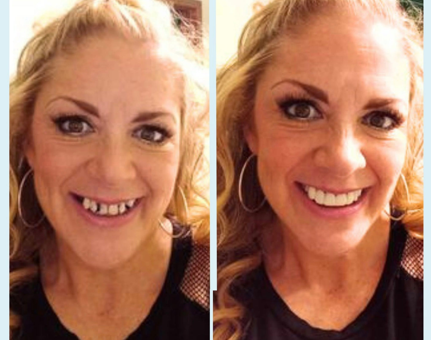 Snap On Smile (CZ) 2