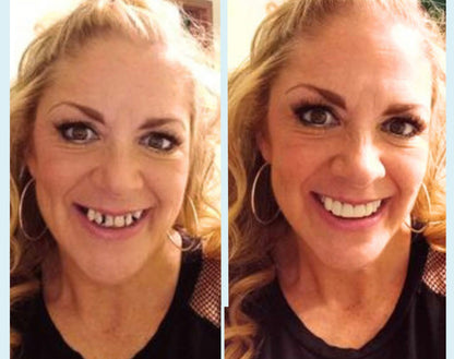 Snap On Smile (CZ) 2