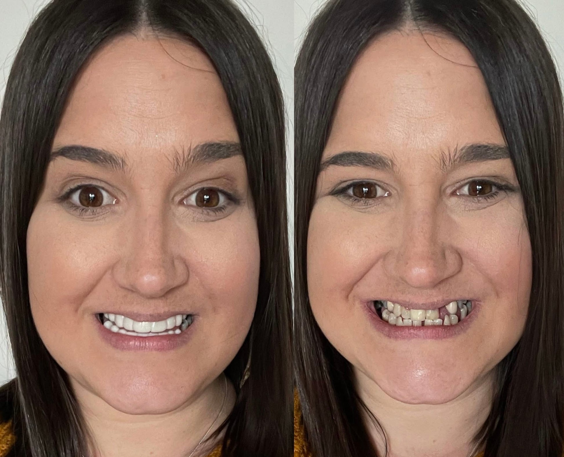 Snap On Smile (CZ) 3