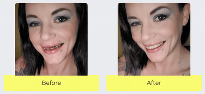 Snap On Smile (CZ) 2