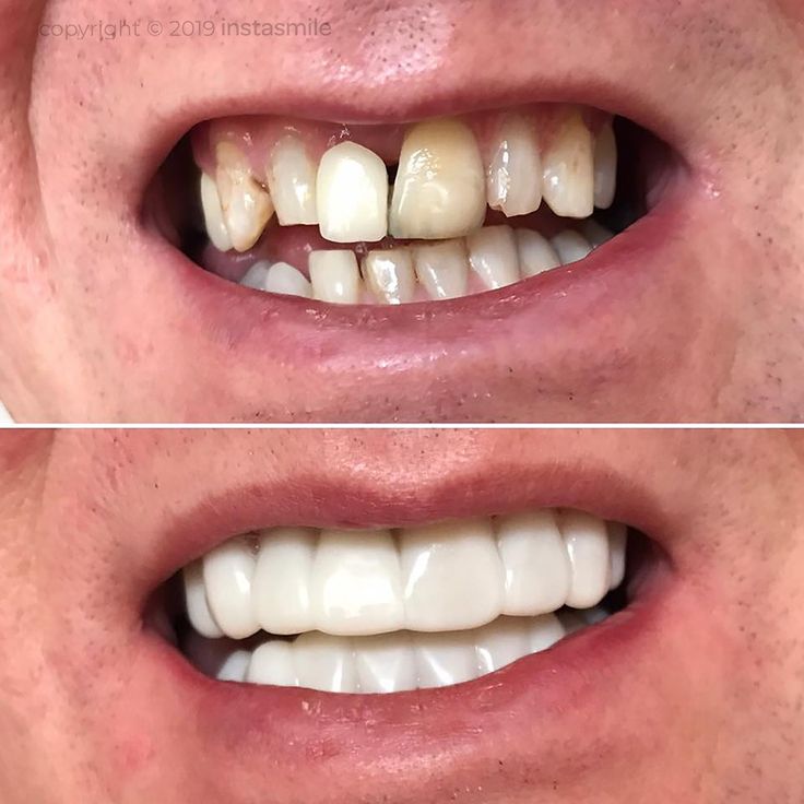 Snap On Smile (CZ) 3