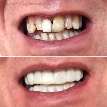 Snap On Smile (CZ) 3