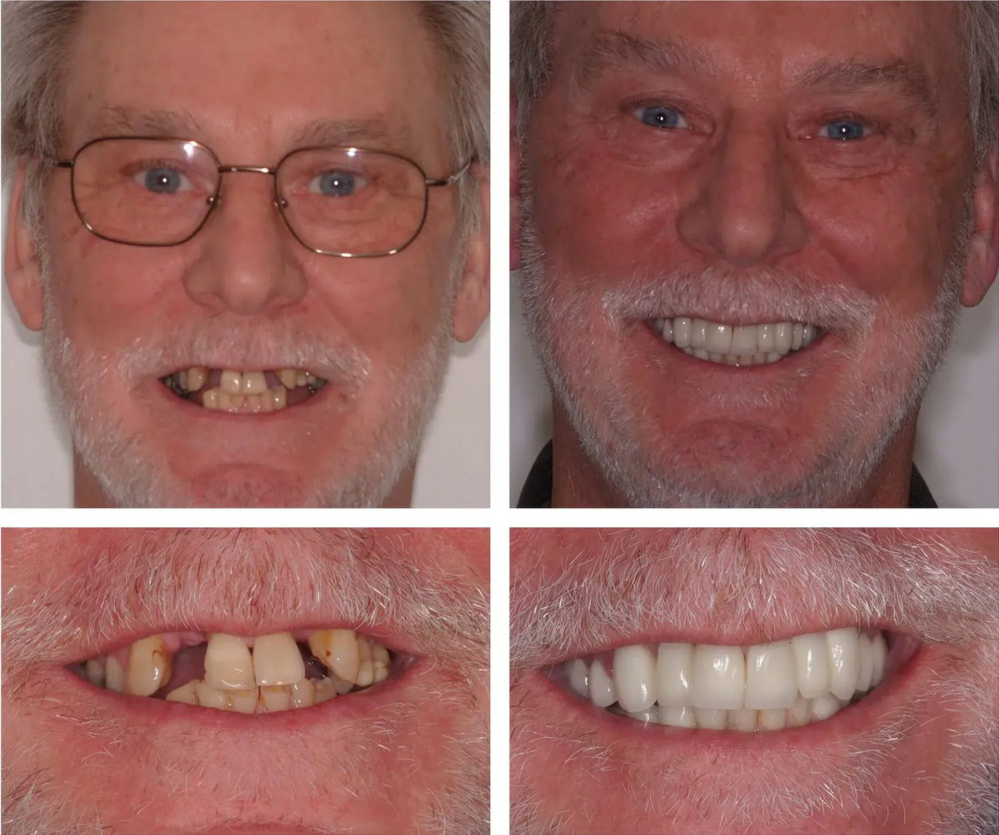 Snap On Smile (CZ) 1