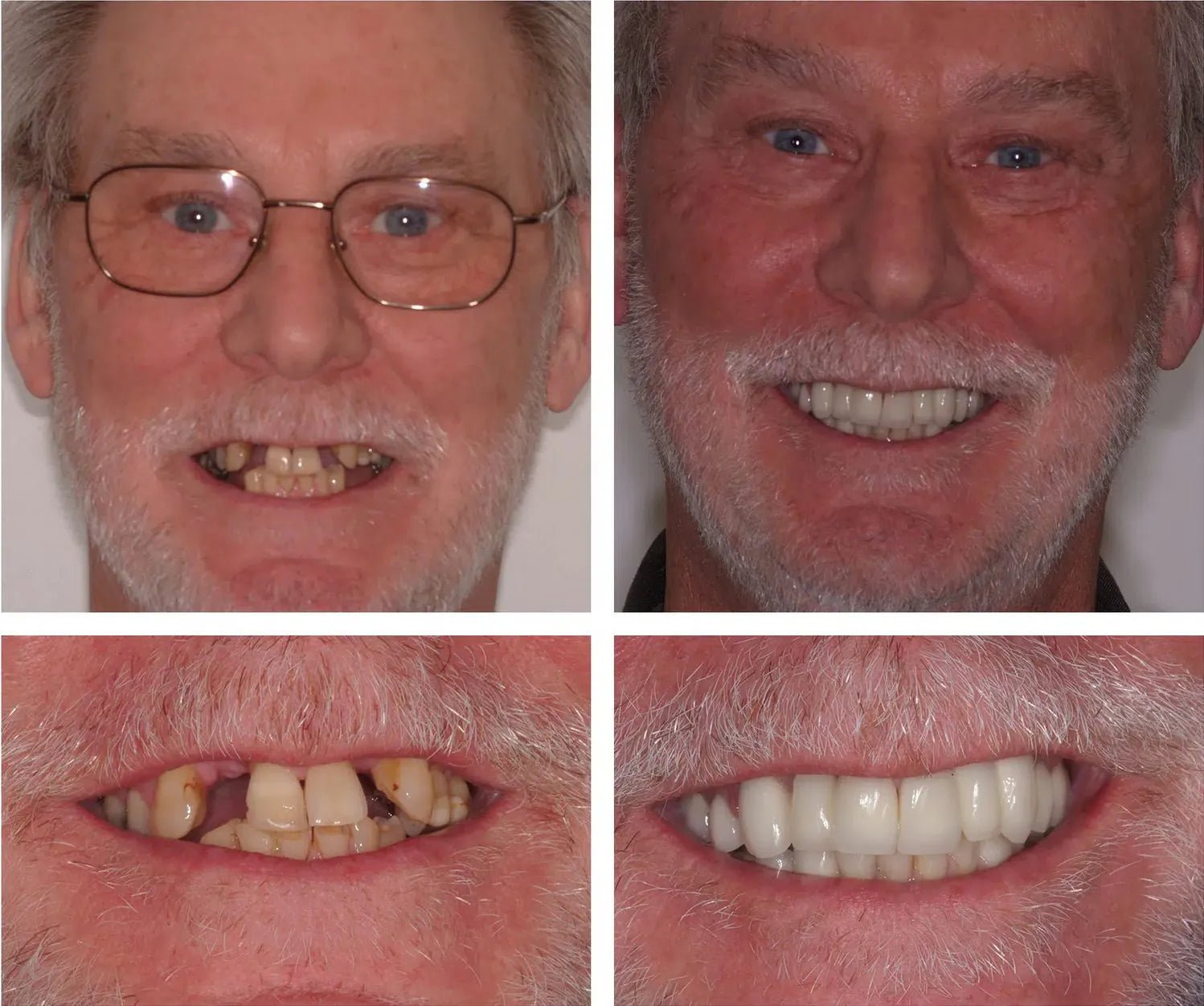 Snap On Smile (CZ) 1